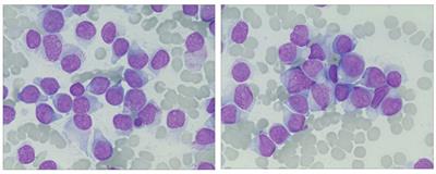 A case report of secondary B-cell acute lymphoblastic leukemia treated with a combination of FLT3 inhibitor and decitabine
